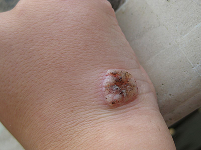 Gross wart on my kid's hand